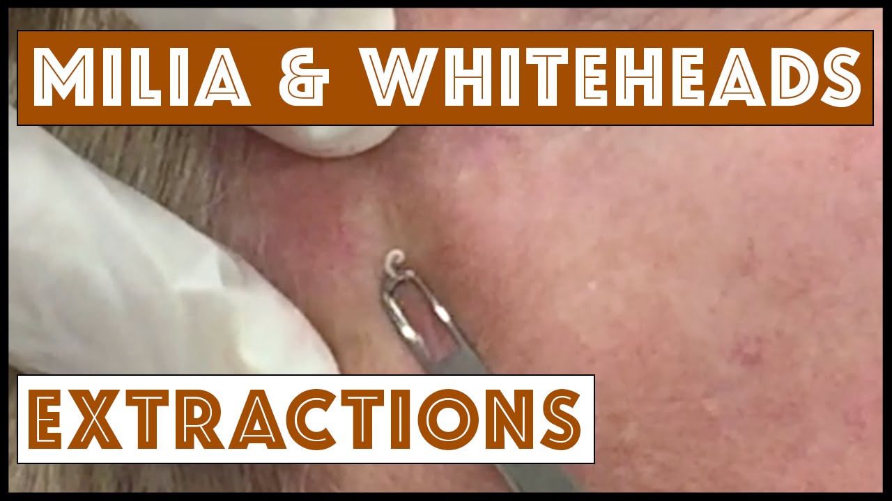 Milia and Whiteheads extracted on the face