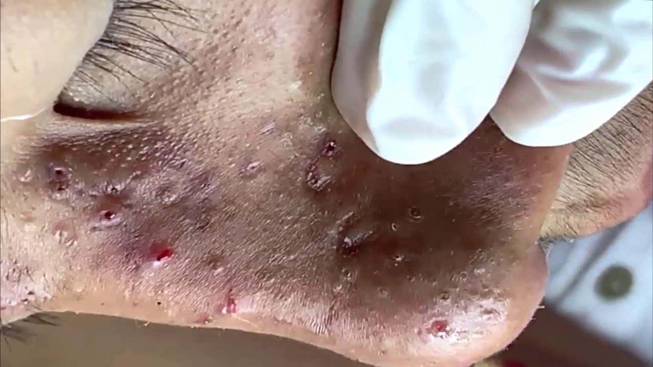 Milia – Big Blackheads Removal – Amazing Pimple Popping Video