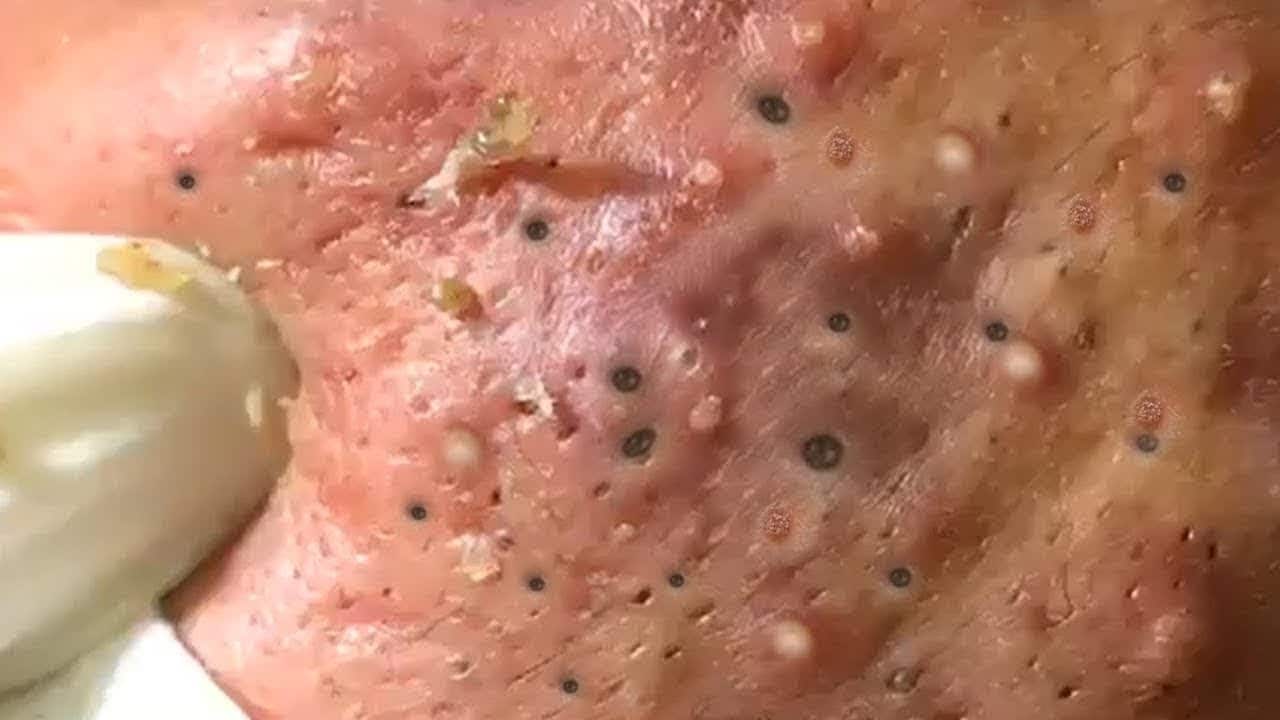 Milia, Big Cystic Acne Blackheads Extraction Whiteheads Removal Pimple Popping #10