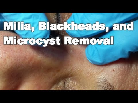 Milia, Blackheads, and Microcyst Removal