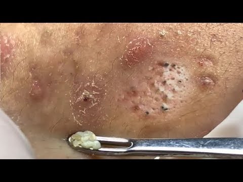 Milia – Blackheads Removal – Best Pimple Popping