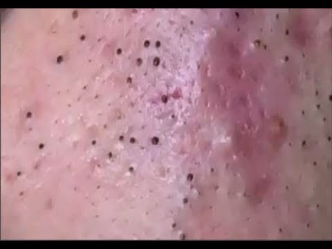 Milia – Blackheads Removal – Best Pimple Popping Tips