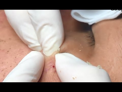 Milia Cysts removal blackhead on face at home, Ep#3