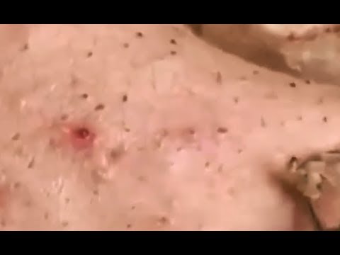 Milia Cysts Removal Blackhead On Face At Home,Ep#15