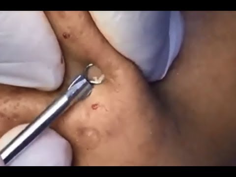 Milia Cysts Removal Blackhead On Face At Home,Ep#14