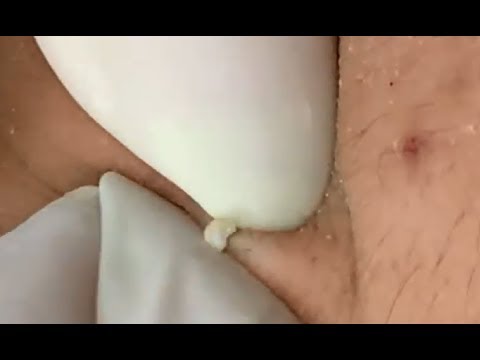 Milia Cysts Removal Blackhead On Face At Home,Ep#13