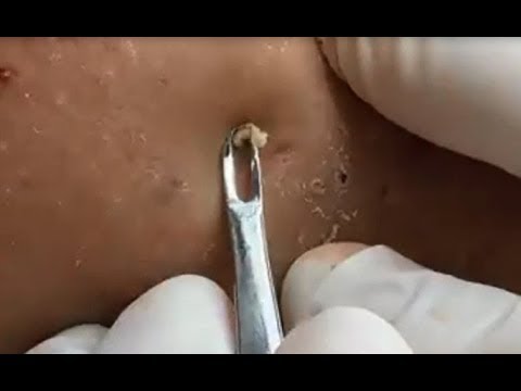 Milia Cysts Removal Blackhead On Face At Home,Ep#12