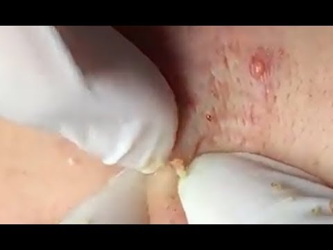 Milia Cysts Removal Blackhead On Face At Home, Ep#8