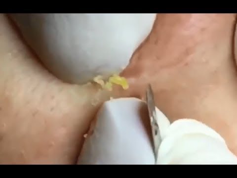 Milia Cysts Removal Blackhead On Face At Home, Ep#7