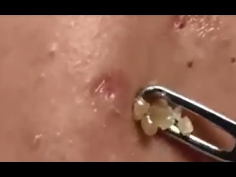 Milia Cysts Removal Blackhead On Face At Home,Ep#17