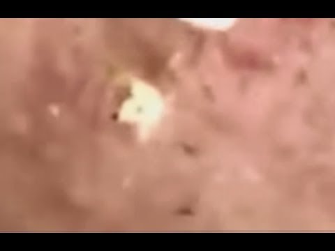 Milia Cysts Removal Blackheads On Face At Home,Ep#45