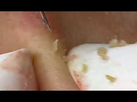 Milia Cysts Removal Blackheads On Face At Home,Ep#42