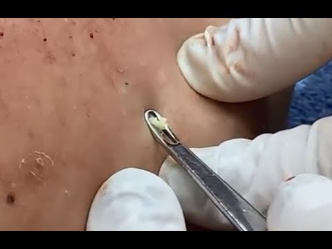 Milia Cysts Removal Blackheads On Face At Home,Ep#40