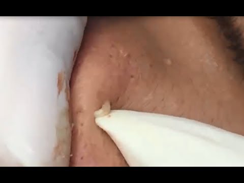 Milia Cysts RemovalBlackhead On Face At Home,Ep#5