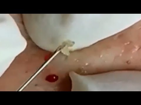 Milia Cytst removal blackhead on face At Home ,Ep#1