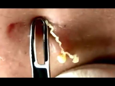 Milia Cytst Removal Blackhead On Face At Home, Ep#2