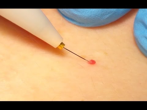 Milia Extraction & Cherry Angioma Removal with Electrolysis