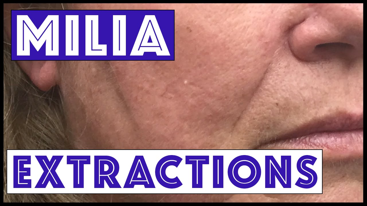Milia extractions, hydrocystoma, after Mohs skin cancer surgery