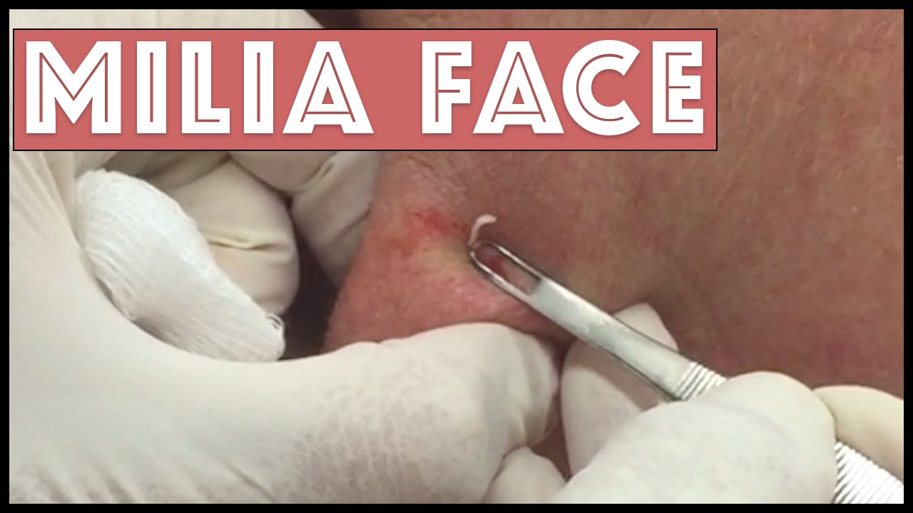 Milia Extractions on the face
