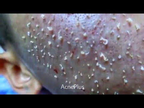 Milia-how to remove blackheads,pimple popping#3,การดูแลรักษาผิวหน้า