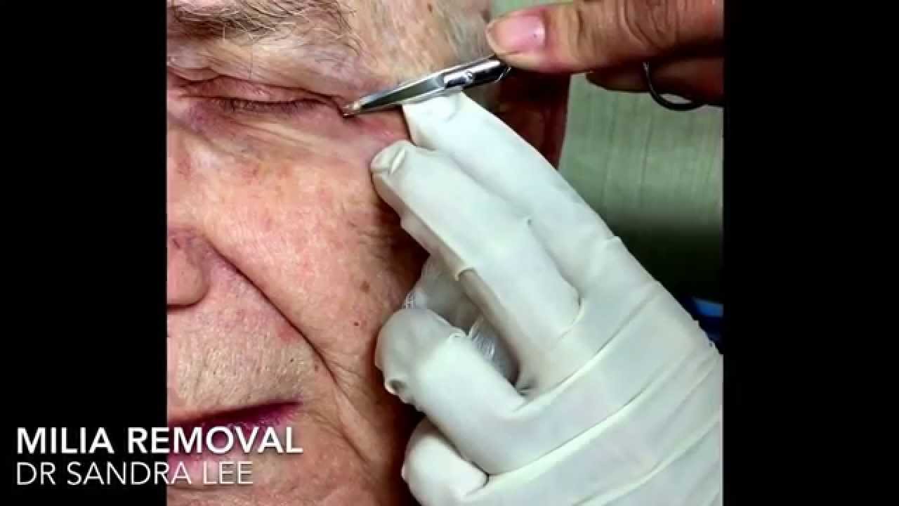 Milia removal compilation + extras.  For medical education- NSFE.