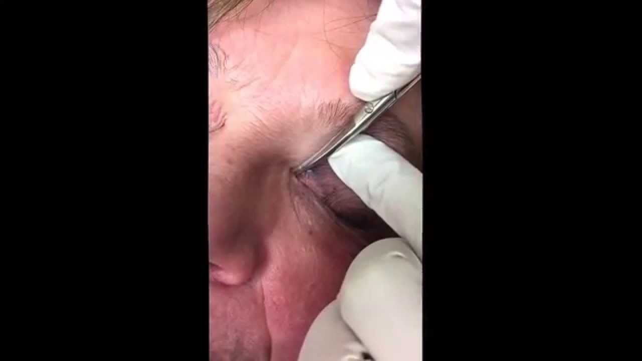 Milia removal on the upper eyelid. For medical education- NSFE.
