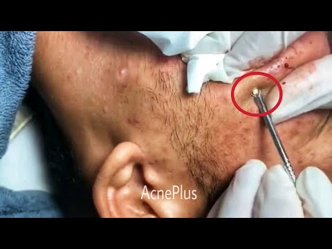 Milia removal,how to remove blackheads,pimple popping#2,การดูแลรักษาผิวหน้า