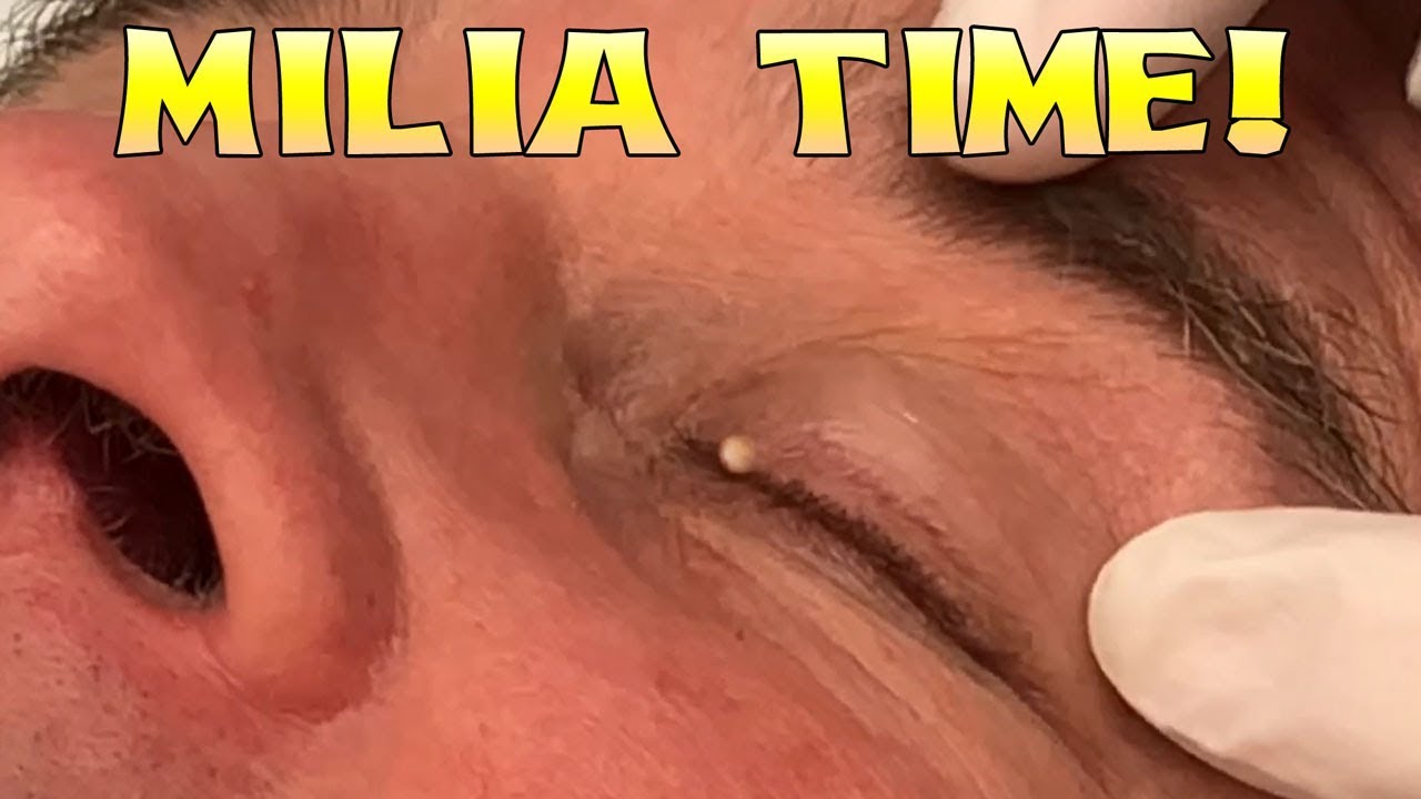 Milia Time! Milium Microcyst Triple Feature