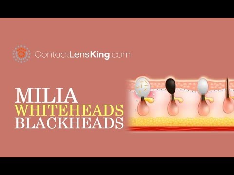 Milia Vs Whiteheads Vs Blackheads | What are the Differences Between Closed and Open Comedones