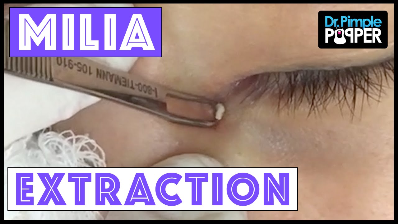 Milium Extraction from a Very Delicate Inner Eye Area