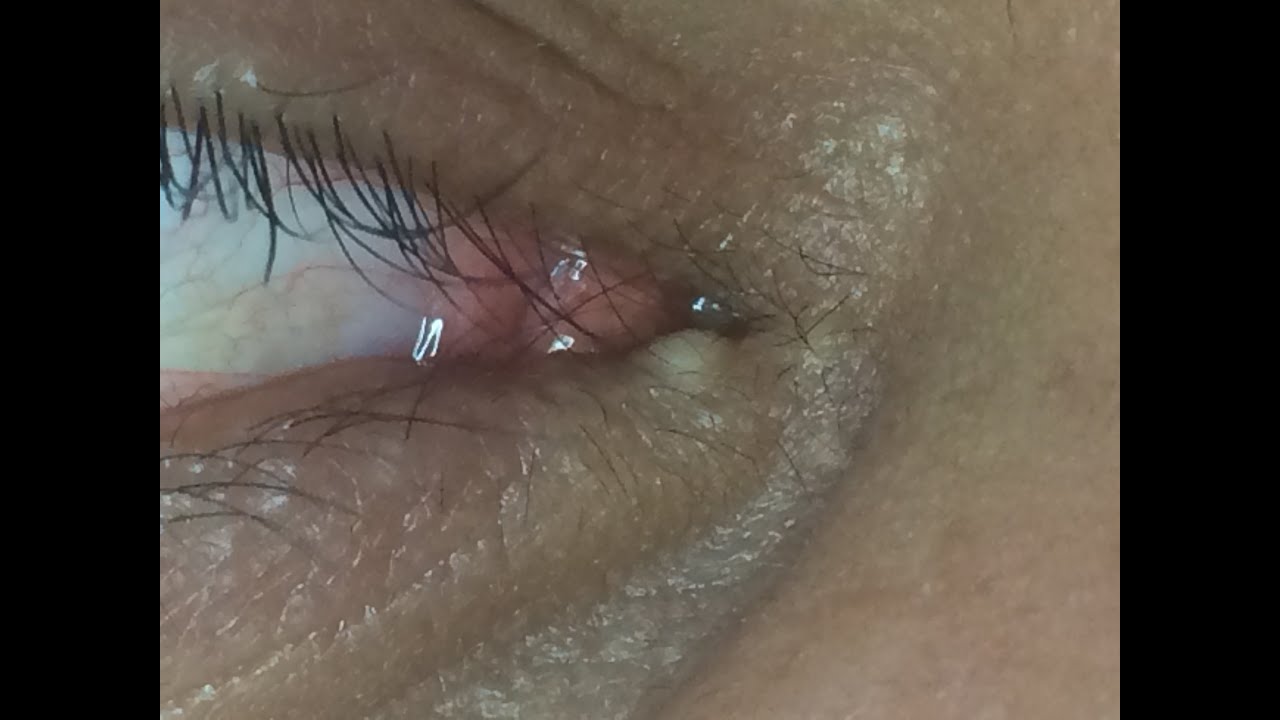 Milium Treatment on Lower Eyelid