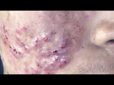 Million of pimples and cysts