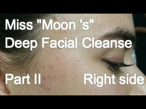 Miss “Moon ‘s”  Deep Facial Cleanse – Part 2 of 2 .Right side