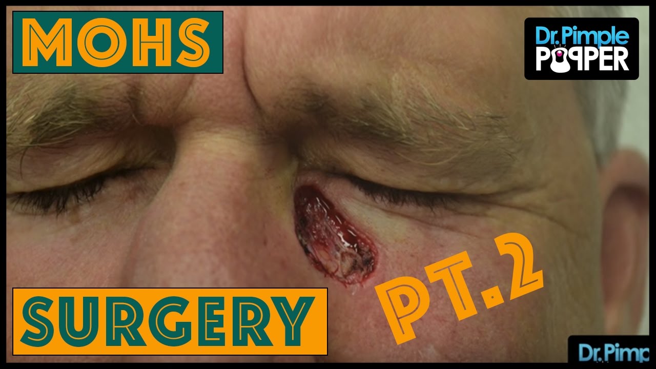 MOHs Surgery: Basal Cell Carcinoma – Pt. 2