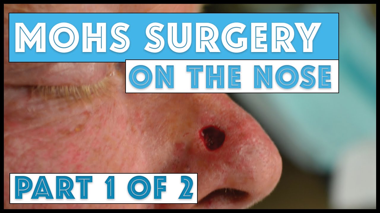 Mohs Surgery on the nose: Part 1 of 2, Taking Mohs Layers