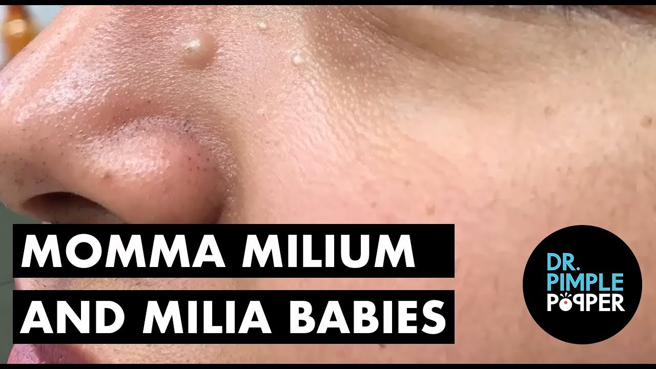 MOMMA Milium & Her Milia Babies