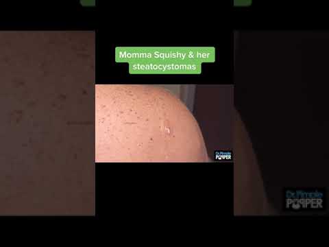 Momma Squishy & Her Steatocystomas Pt.1 | Dr. Pimple Popper #drpimplepopper  #shorts