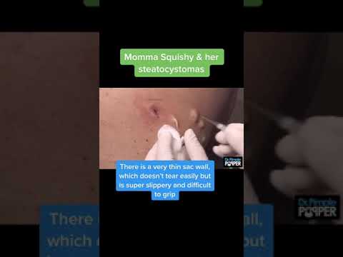 Momma Squishy & Her Steatocystomas Pt. 2 The Sac Removal | Dr. Pimple Popper #drpimplepopper #shorts