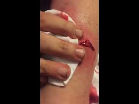 Monster cyst on arm popped!! Snap crackle pop?☠️