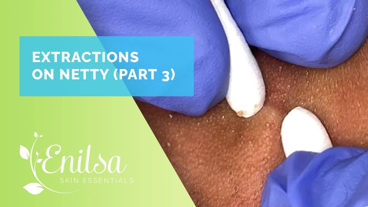 More Blackhead Extractions on Netty – Third Treatment