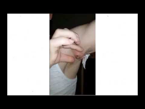 MOST Disturbing Pimple Popping Video EVER #OMG  – 2020 (CRAZY)(OMG)
