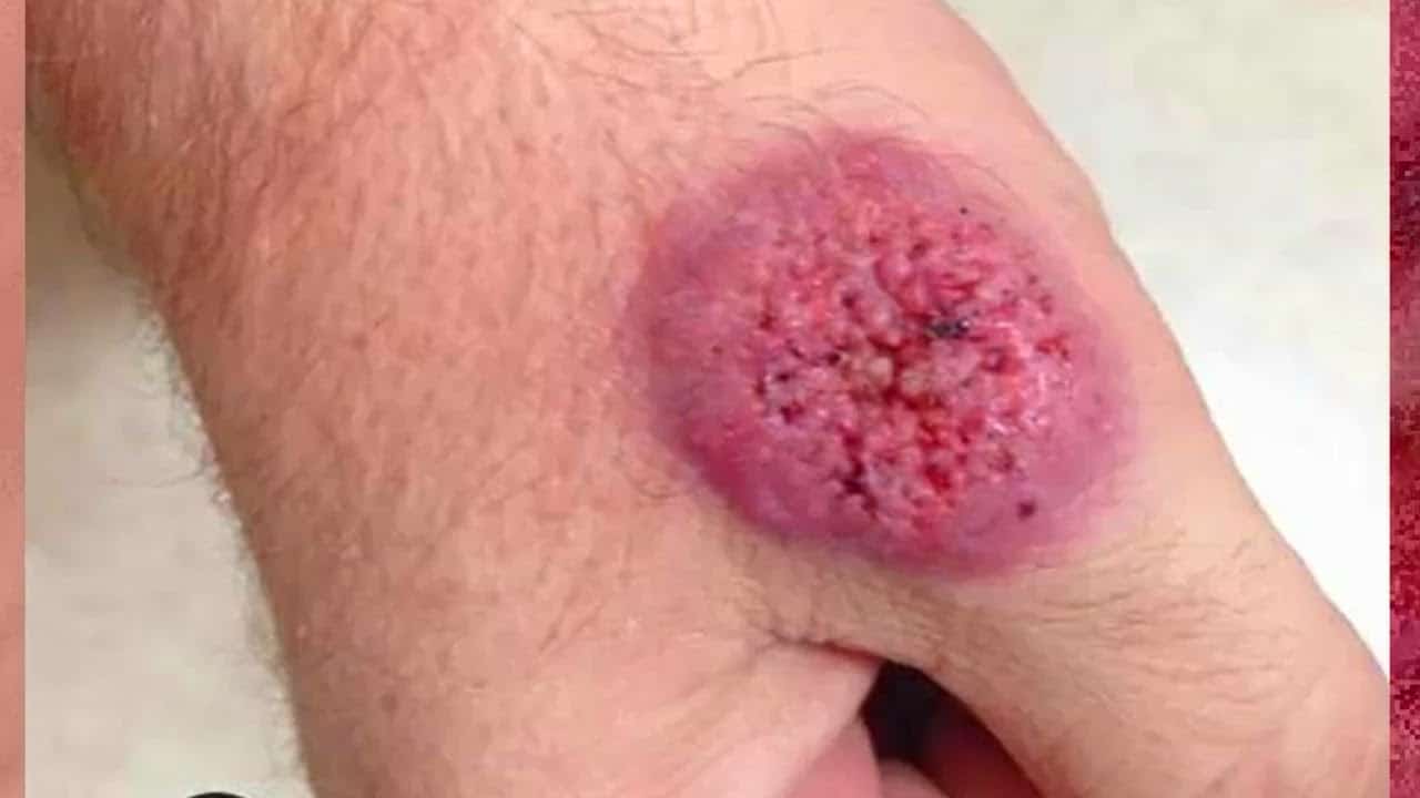 Most Extreme Medical Conditions!  Tumors, Cysts and Popping