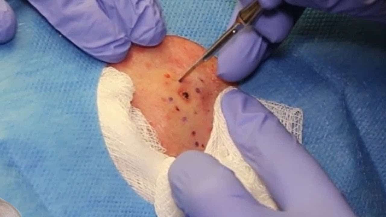 Most Popular DPoWs Dilated Pores, Blackheads and Cysts! Pimple Popping