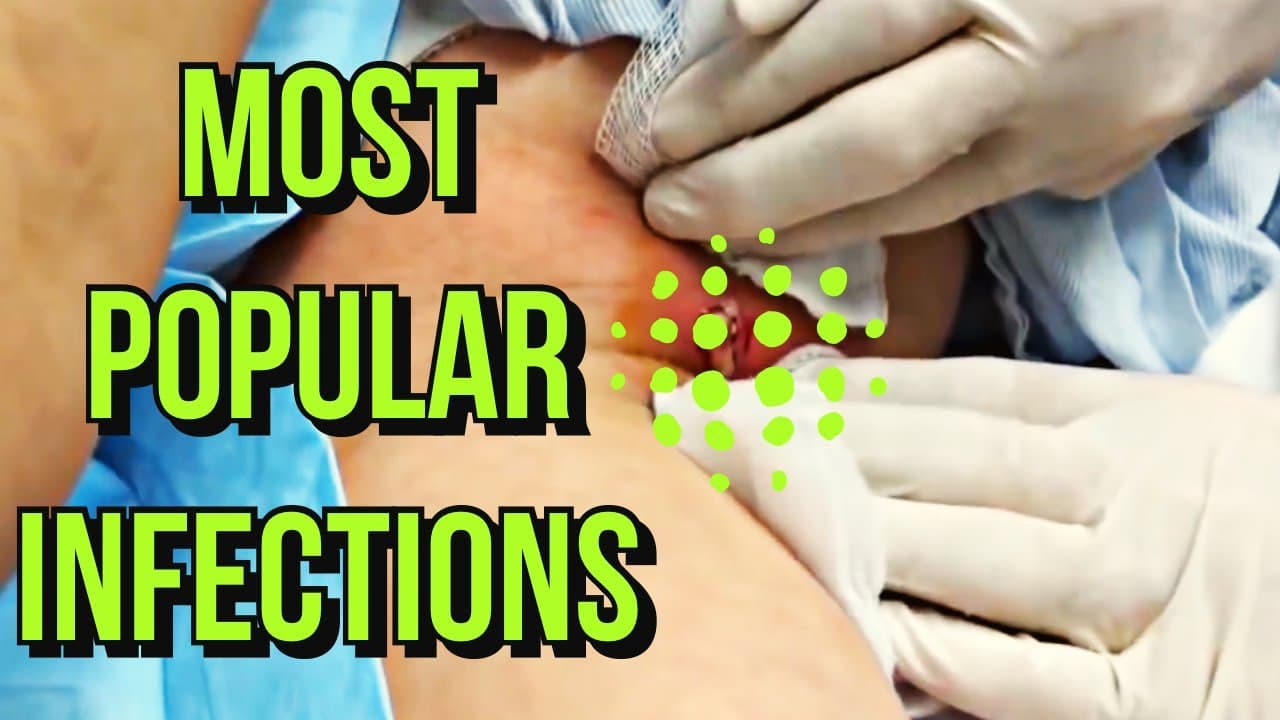 Most Popular Infected Cysts on YouTube