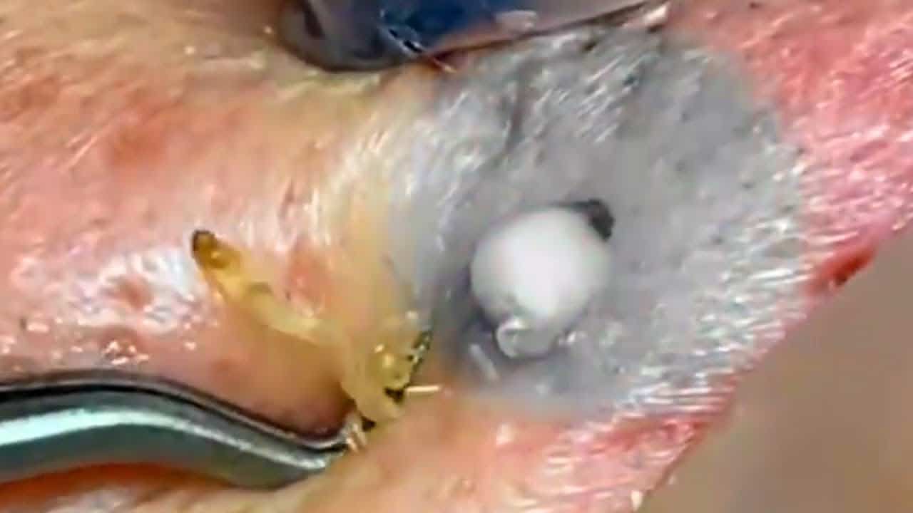 Most Popular Pimples and Cysts!  10 Million Views