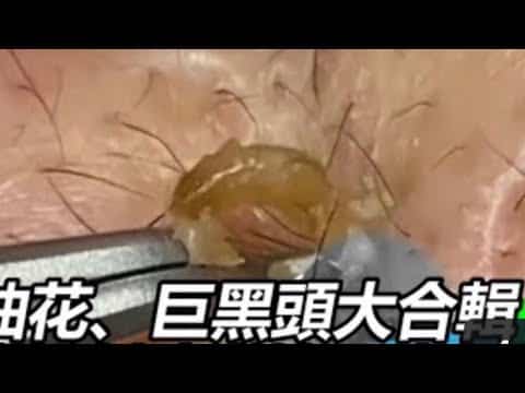 Most Popular Pimples!  Dr. Popper's Comedone Documentary!  Pimple Popping
