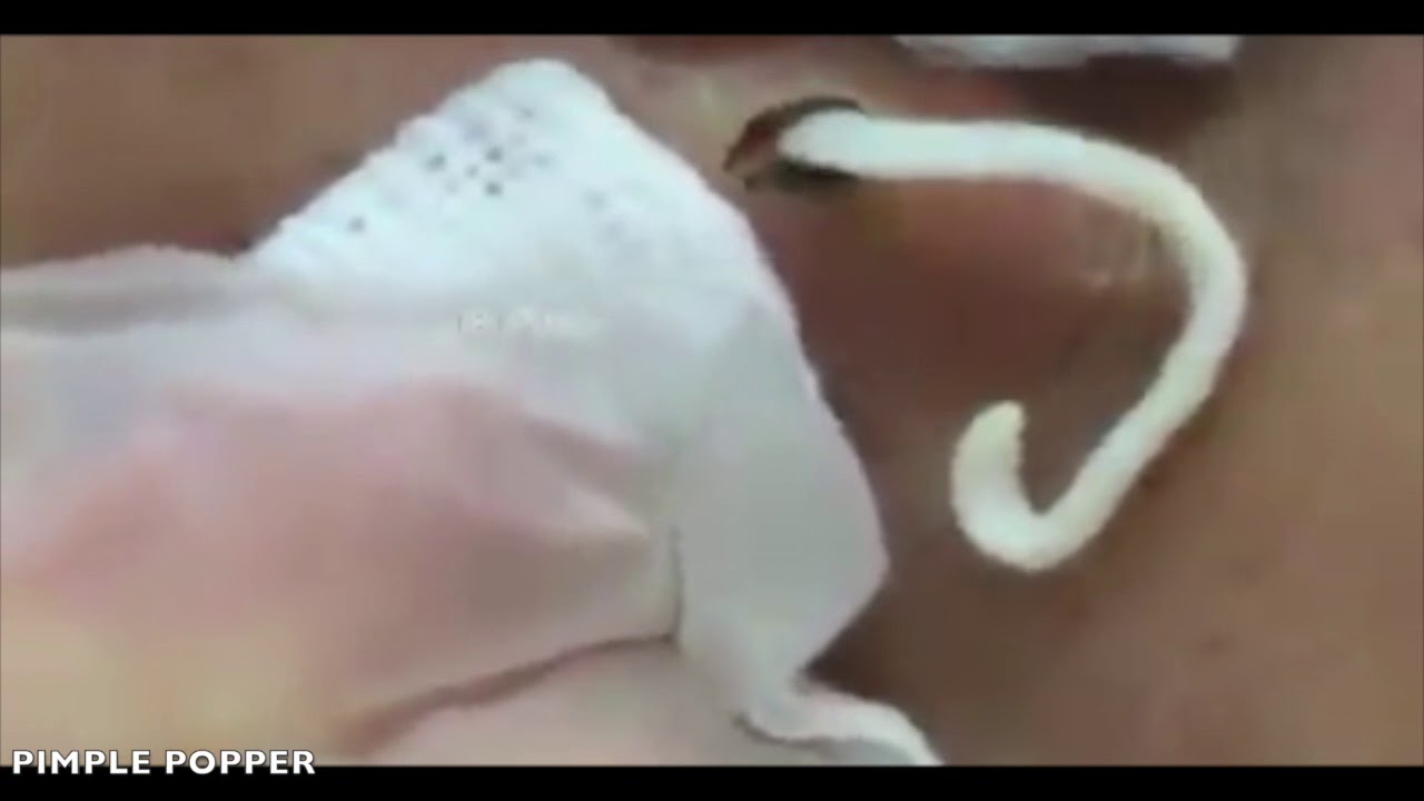 Most satisfying Big Stringy Sebaceous Cyst Popping!