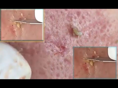 Most Satisfying Blackheads extraction , Whiteheads Removal and Cysts popping #39