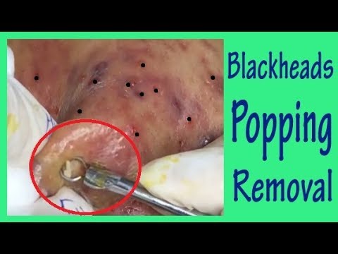 Most Satisfying Deep Blackheads, Large Blackheads Pimple Popping-Blackheads Removal