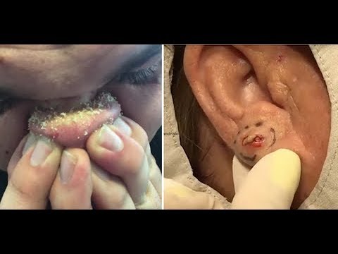 MOST SATISFYING PIMPLE POPPING APRIL 2019 Compilation 2 ???